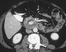 Pseudoaneurysm of the Gastroduodenal Artery - CTisus CT Scan