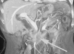 Cancer of the Pancreas Invades the Superior Mesenteric Vein (SMV) - CTisus CT Scan