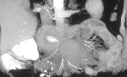 Pseudoaneurysm - CTisus CT Scan