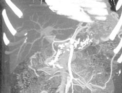 Chronic Pancreatitis - CTisus CT Scan