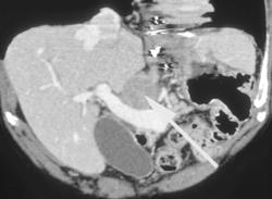 Pancreatic Cancer - CTisus CT Scan