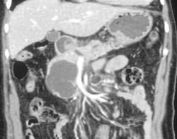 Pancreatic Cytstadenoma - CTisus CT Scan