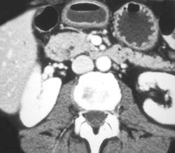 Dilated Common Duct Due to An Ampullary Tumor - CTisus CT Scan