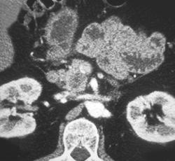 Subtle Carcinoma of the Pancreas - CTisus CT Scan