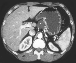 Cystadenoma of the Pancreas - CTisus CT Scan