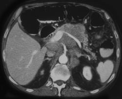 Lymphoma Infiltrating the Pancreas With Adenopathy - CTisus CT Scan