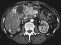 Islet Cell Tumor of the Pancreas With Embolized Liver Metastases - CTisus CT Scan