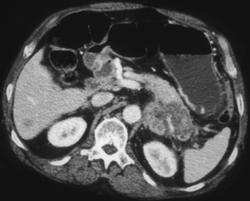 Pancreatic Cancer - Pancreatic Tail- With Liver Metastases - CTisus CT Scan