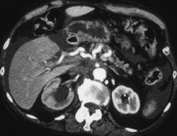 Pancreatic Cancer With Vascular & Peripancreatic Invasion - CTisus CT Scan