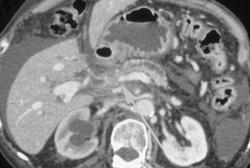 Invasive Pancreatic Cancer With Extensive Collaterals - CTisus CT Scan