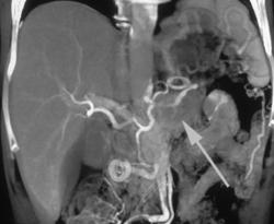 Pancreatic Cancer With Invasion of the Splenic Artery & Vein With Collaterals - CTisus CT Scan