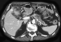 Cancer of the Pancreas With Carcinomatosis - CTisus CT Scan