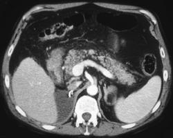 Pancreatitis Following Right Nephrectomy - CTisus CT Scan