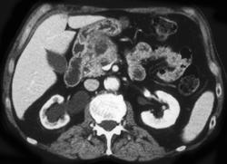 Cancer of the Pancreatic Head - CTisus CT Scan