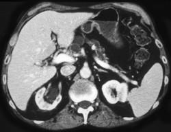 Cancer of the Pancreas With A Dilated Pancreatic Duct - CTisus CT Scan