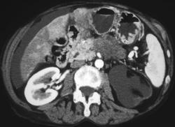 Pancreatic Cancer With Ascites - CTisus CT Scan