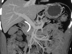 Pancreatic Cancer With Invasion of the Superior Mesenteric Vein (SMV) - CTisus CT Scan