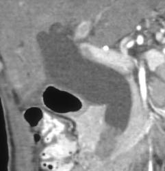 Dilated Common Bile Duct With Distal Common Duct Tumor - CTisus CT Scan