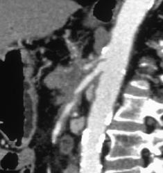 Pancreatic Cancer With Encasement of the Celiac Artery & SMA - CTisus CT Scan