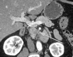 Pancreatic Cancer With Invasion of the SMA - CTisus CT Scan