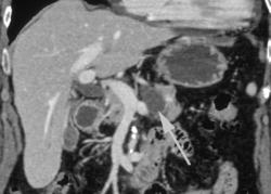 Pancreatic Cyst With Incidental Liver Arteriovenous Malformation (AVM) - CTisus CT Scan