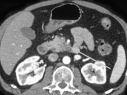 Subtle Invasion of the SMA By Pancreatic Cancer - CTisus CT Scan