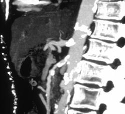 Calcification of the Origin of the Celiac & SMA in Preoperative Evaluation - CTisus CT Scan