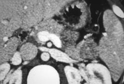 Insulinoma of the Pancreatic Tail - Hypovascular - CTisus CT Scan