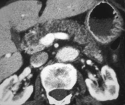 Fatty Infiltration of the Pancreatic Gland - CTisus CT Scan