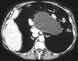 Pseudocyst - CTisus CT Scan