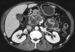 Intraductal Papillary Mucinous Tumor (IPMT) With Early Carcinoma Within the Mass - CTisus CT Scan