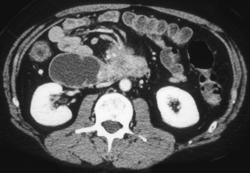 Invasive Pancreatic Cancer Also Obstructing the Duodenum - CTisus CT Scan