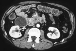 Duodenal Encasement By Pancreatic Cancer - CTisus CT Scan