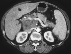 Lymphoma Infiltrates the Pancreas and Perinephric Tissues - CTisus CT Scan