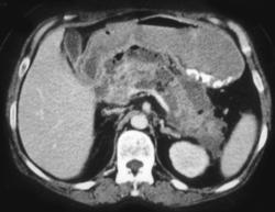 Pancreatic Necrosis With Abscess - CTisus CT Scan