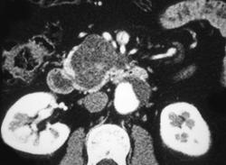 Intraductal Papillary Mucinous Tumor (IPMT) of the Pancreatic Head & Uncinate Process - CTisus CT Scan