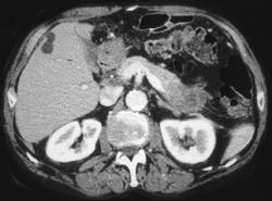 Invasive Carcinoma of the Pancreatic Tail With Infarcted Splenic Tissue - CTisus CT Scan