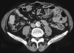 Cystadenocarcinoma of Tail of Pancreas W/ Implants on Undersurface of Liver - CTisus CT Scan