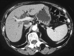 Dilated Pancreatic Common Bile Duct - CTisus CT Scan