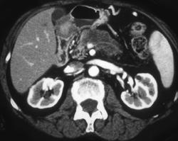 Carcinoma of the Body of the Pancreas With Splenic Vein Invasion - CTisus CT Scan