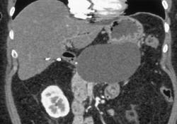 Pseudocyst - CTisus CT Scan