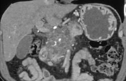 Cystadenocarcinoma Invades the Mesenteric Vessel - CTisus CT Scan