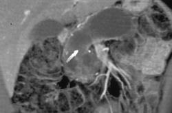 Intraductal Papillary Mucinous Tumor (IPMT) of the Pancreas With A Stent in the Pancreatic Duct - CTisus CT Scan