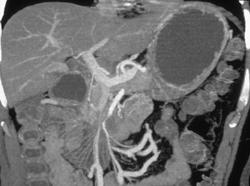 SMA & Duodenal Invasion. Nice Collaterals - CTisus CT Scan