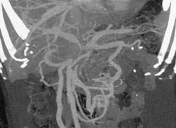 Pancreatic Cancer Invades the Superior Mesenteric Vein (SMV) & Portal Vein - CTisus CT Scan