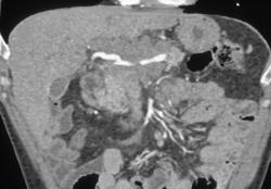 Pancreatic Cancer Invades the Celiac Artery - CTisus CT Scan