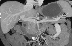 Pancreatic Cancer With Superior Mesenteric Artery (SMA) & Superior Mesenteric Vein (SMV) Invasion - CTisus CT Scan