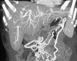 Intraductal Papillary Mucinous Tumor (IPMT) W/ Invasion of the Splenic Vein With Collaterals - CTisus CT Scan