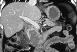 Intraductal Papillary Mucinous Tumor (IPMT) With Carcinoma of the Pancreatic Head With Minimum Intensity Projection - CTisus CT Scan