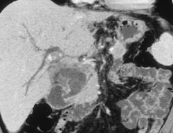 Dilated Common Bile Duct With Invasion of the Duct By Carcinoma - CTisus CT Scan